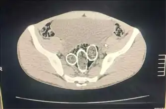 Büyük Uyuşturucu Operasyonu: 320 Gram Ele Geçirildi